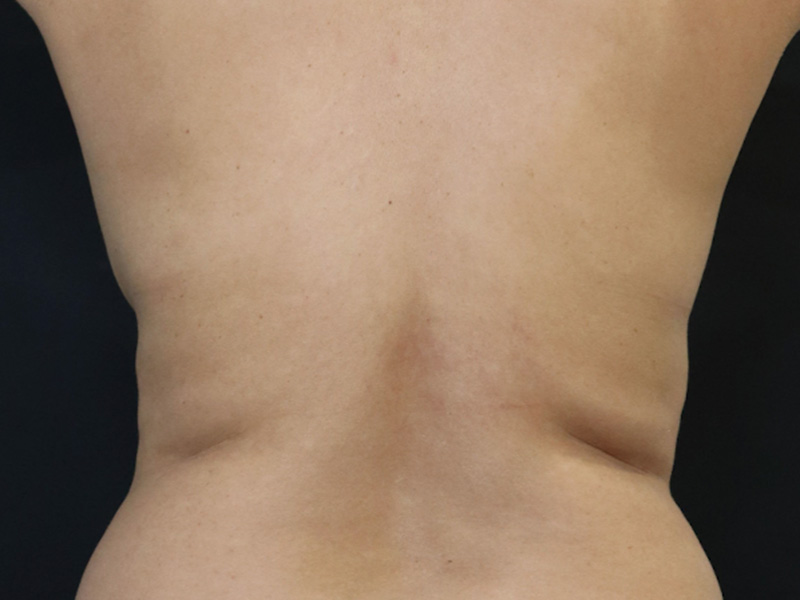 New Jersey Liposuction Before Back