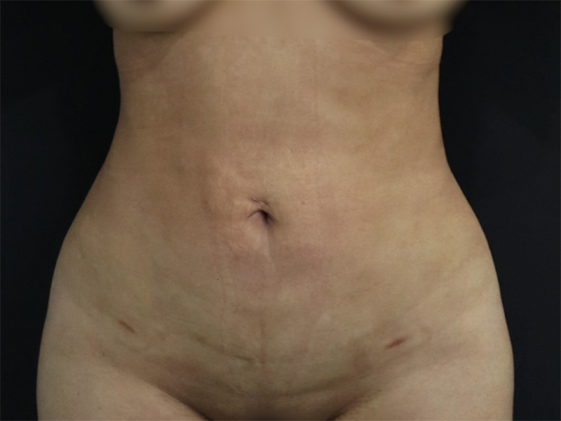 New Jersey Liposuction Before And After Front