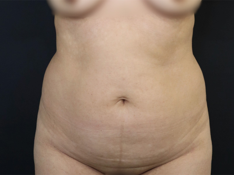 New Jersey Liposuction Before Front