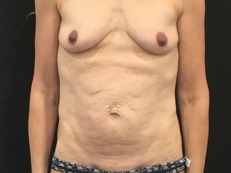 New Jersey Mommy Makeover Front Before