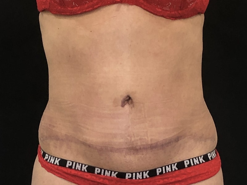 New Jersey Tummy Tuck Front After