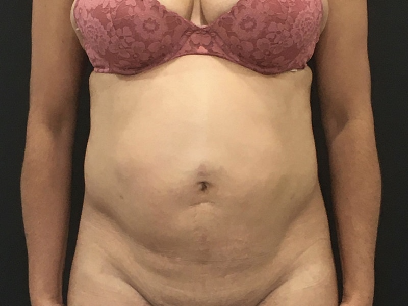 New Jersey Tummy Tuck Front Before