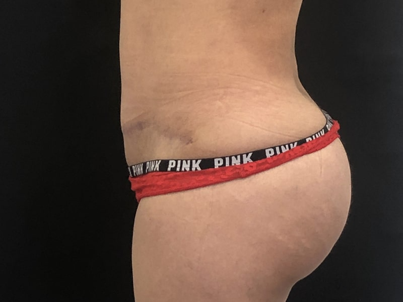 New Jersey Tummy Tuck Lateral After