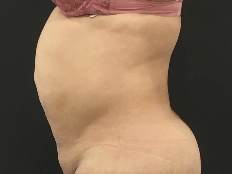New Jersey Tummy Tuck Lateral Before