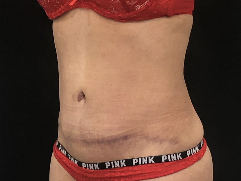 New Jersey Tummy Tuck Oblique After