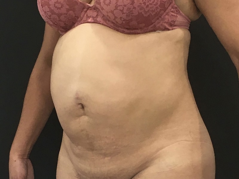 New Jersey Tummy Tuck Oblique Before