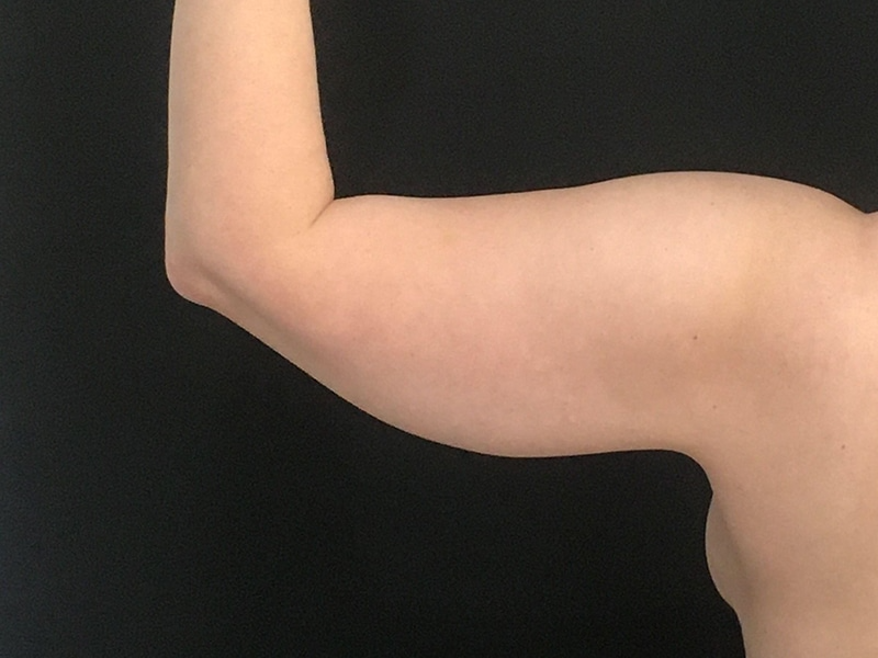 New Jersey Armlift Posterior Before
