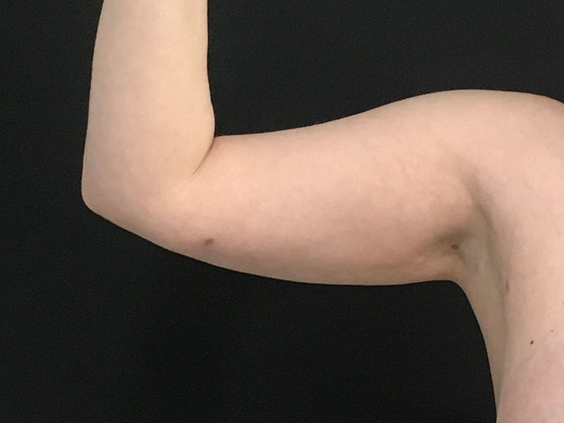 New Jersey Liposuction Anterior After