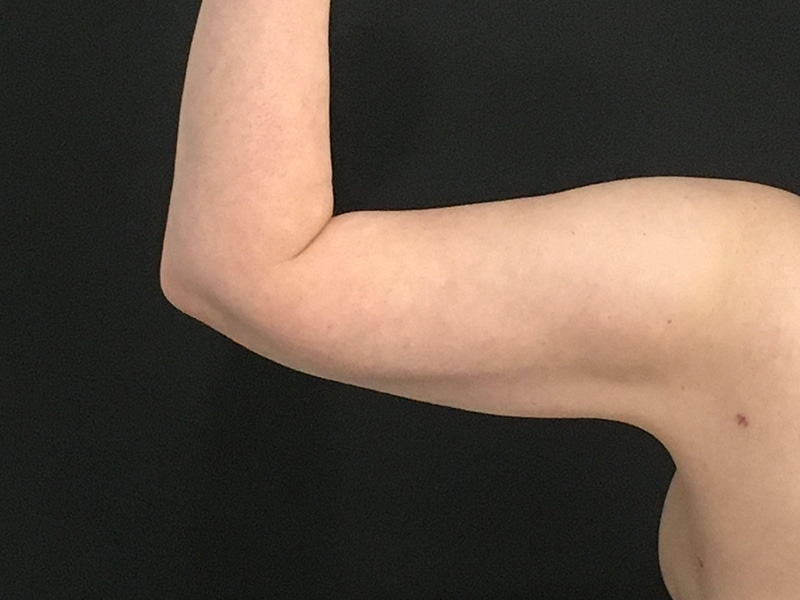 New Jersey Liposuction Posterior After