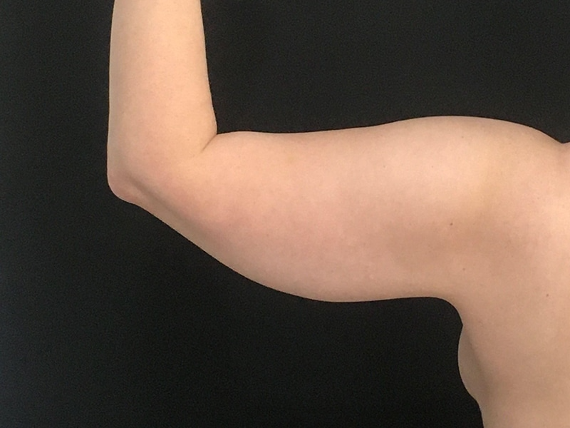 New Jersey Liposuction Posterior Before