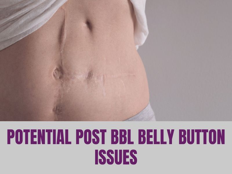 Potential Post BBL Belly Button Issues