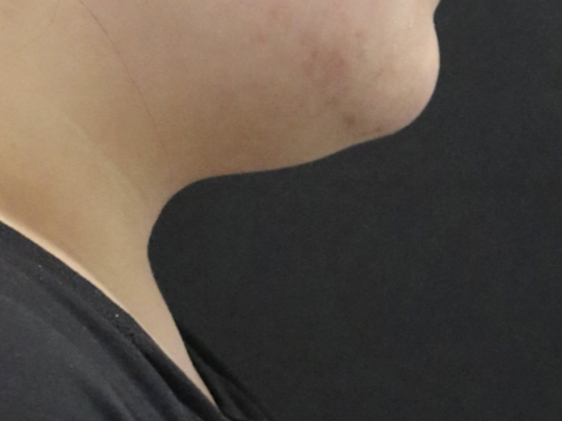 Right Lateral Before