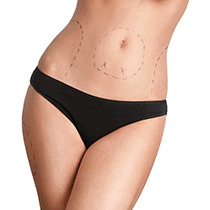 Scar Revision Surgery New Jersey