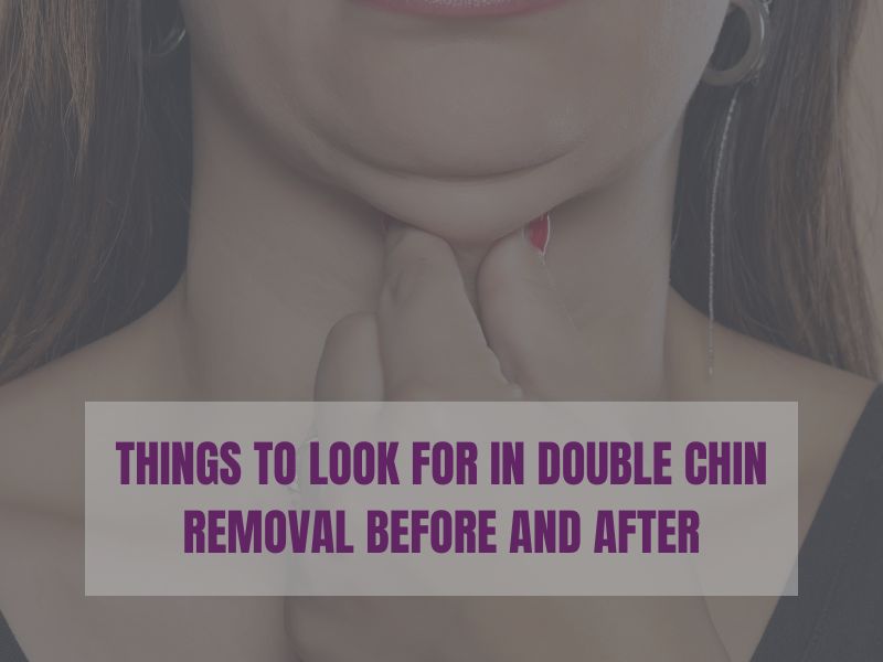 Things to Look for in Double Chin Removal Before and After