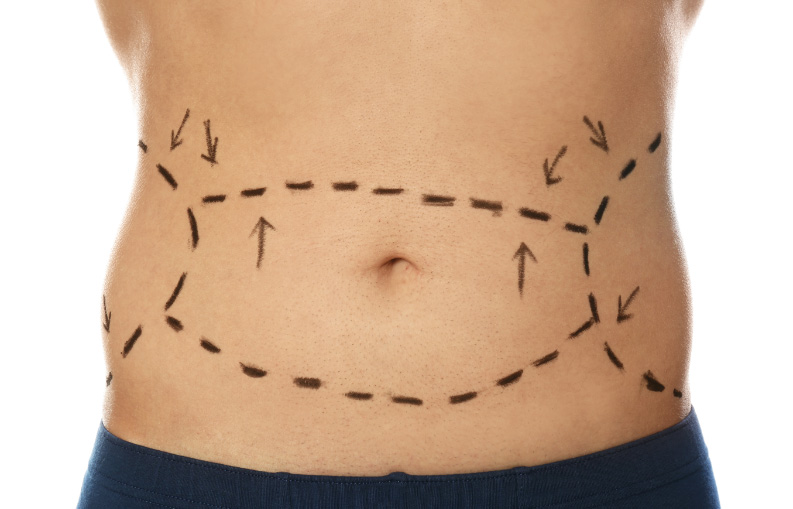 Tummy Tuck After Weight Loss
