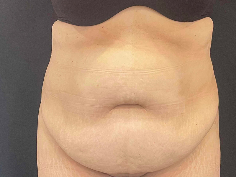 Tummy Tuck New Jersery Photos Front Before