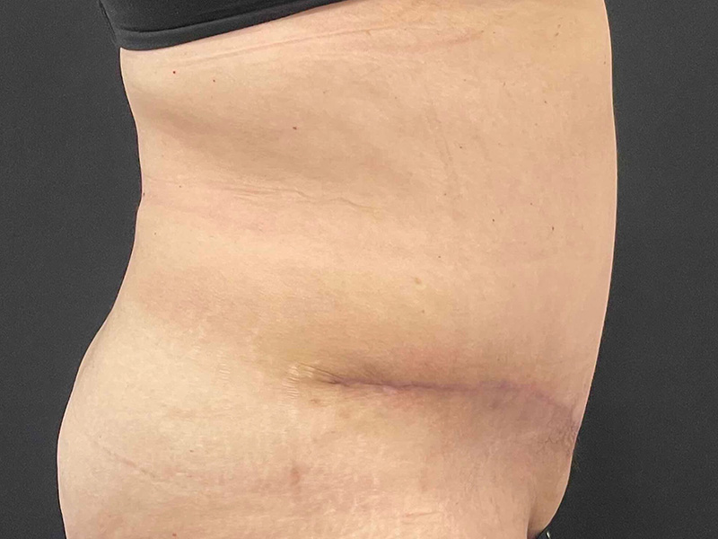 Tummy Tuck New Jersery Photos Lateral After