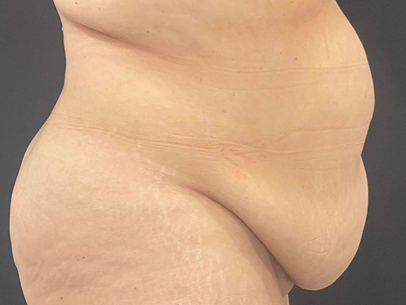 Tummy Tuck New Jersery Photos Lateral Before