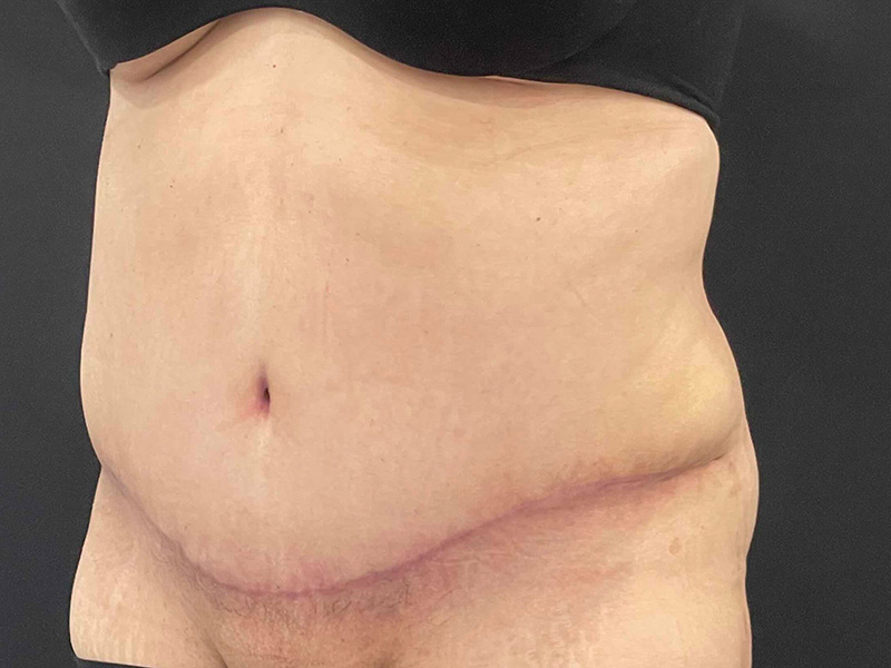 Tummy Tuck New Jersery Photos Oblique After