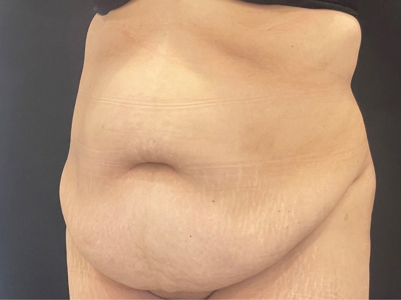 Tummy Tuck New Jersery Photos Oblique Before