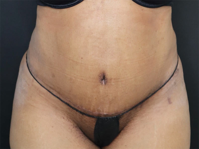 Tummy Tuck New Jersey Patient 5 Front After