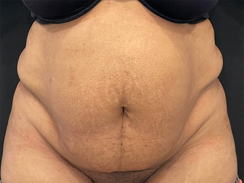 Tummy Tuck New Jersey Patient 5 Front Before