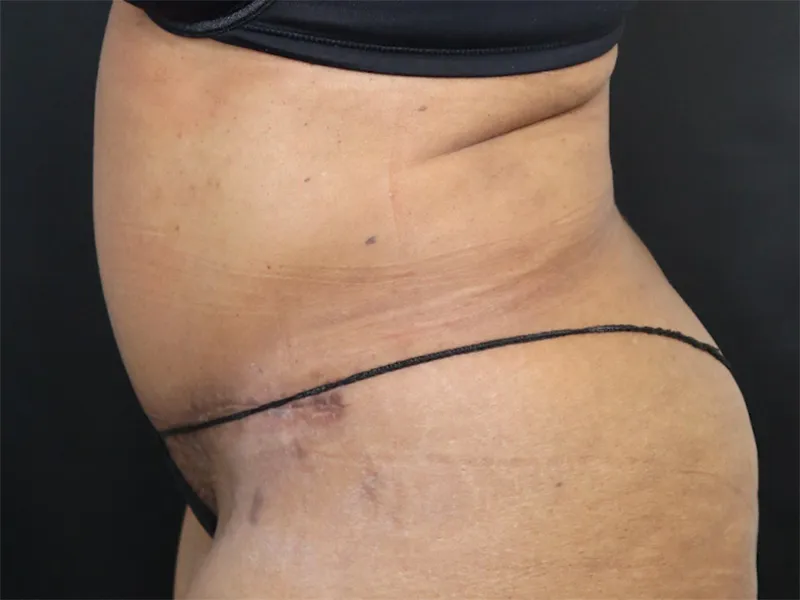 Tummy Tuck New Jersey Patient 5 Lateral After