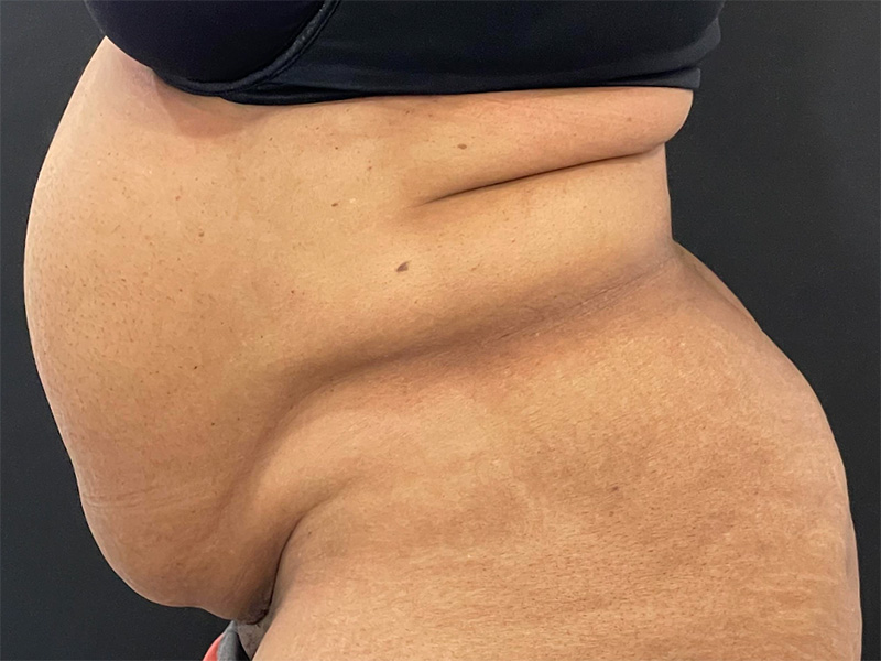 Tummy Tuck New Jersey Patient 5 Lateral Before
