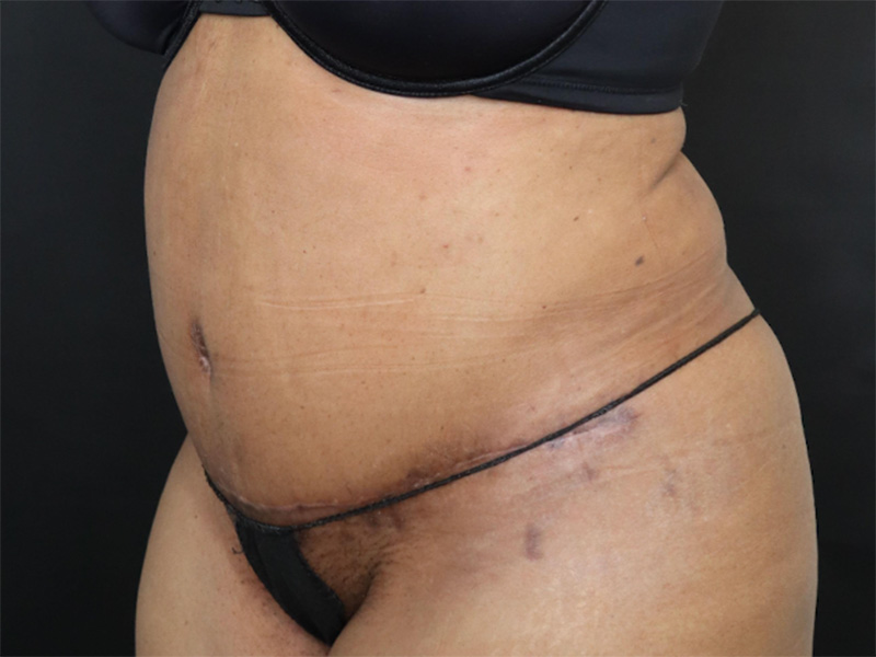 Tummy Tuck New Jersey Patient 5 Oblique After