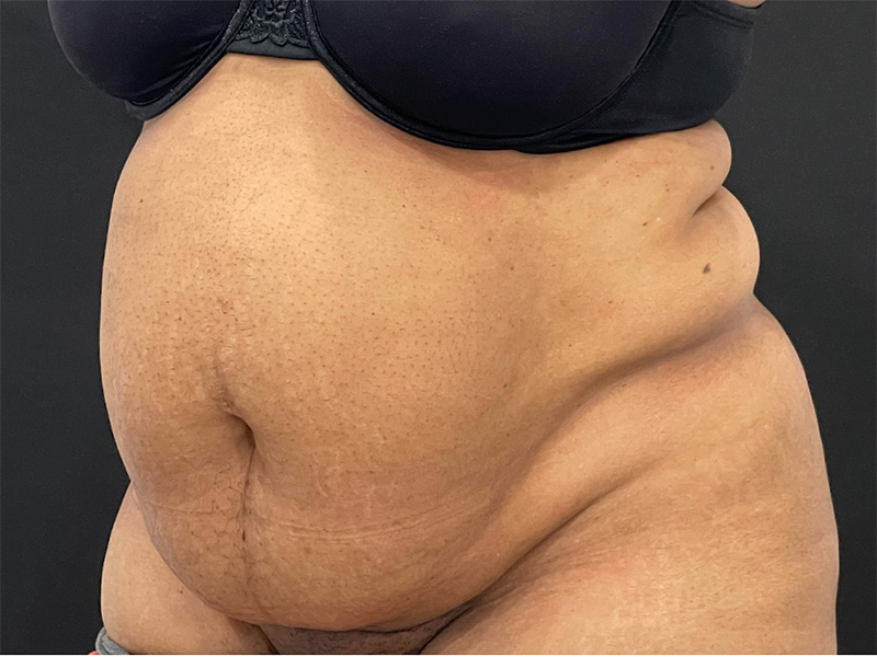 Tummy Tuck New Jersey Patient 5 Oblique Before