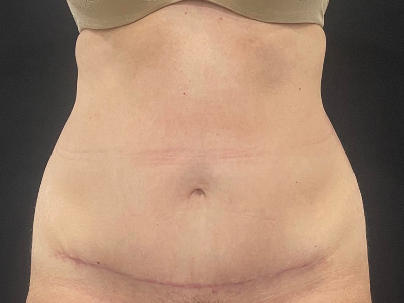 Tummy Tuck New Jersey Patient 6 Front After