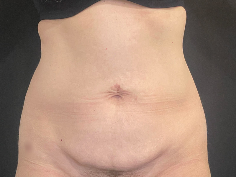 Tummy Tuck New Jersey Patient 6 Front Before
