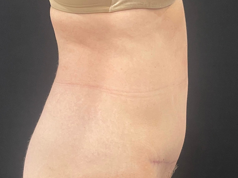 Tummy Tuck New Jersey Patient 6 Lateral After