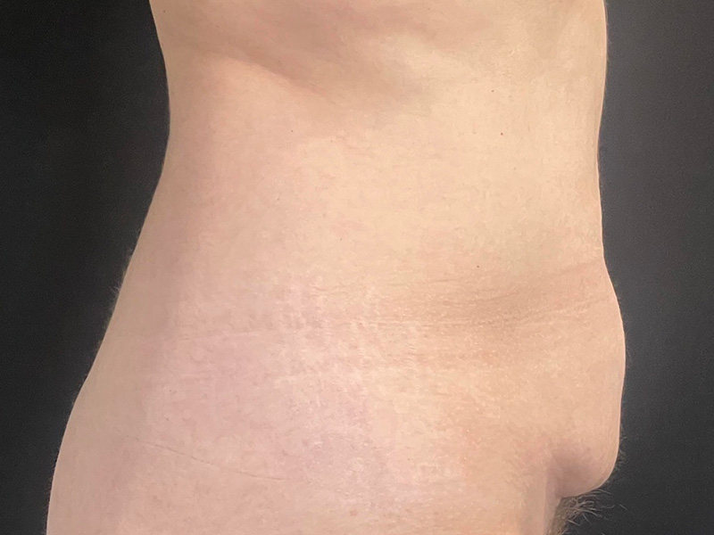 Tummy Tuck New Jersey Patient 6 Lateral Before