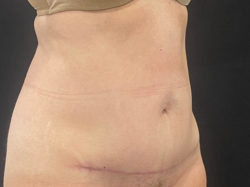 Tummy Tuck New Jersey Patient 6 Oblique After