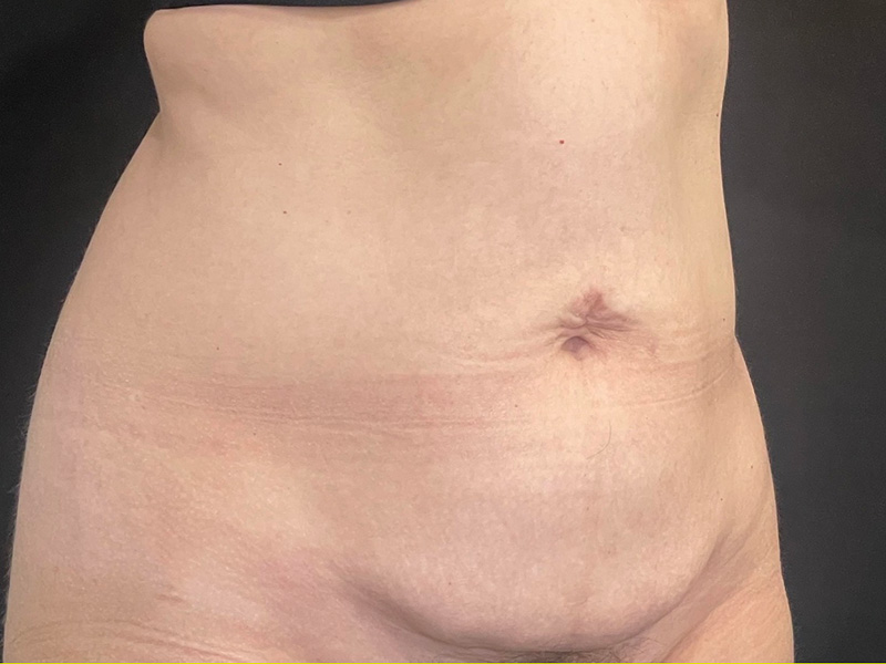Tummy Tuck New Jersey Patient 6 Oblique Before