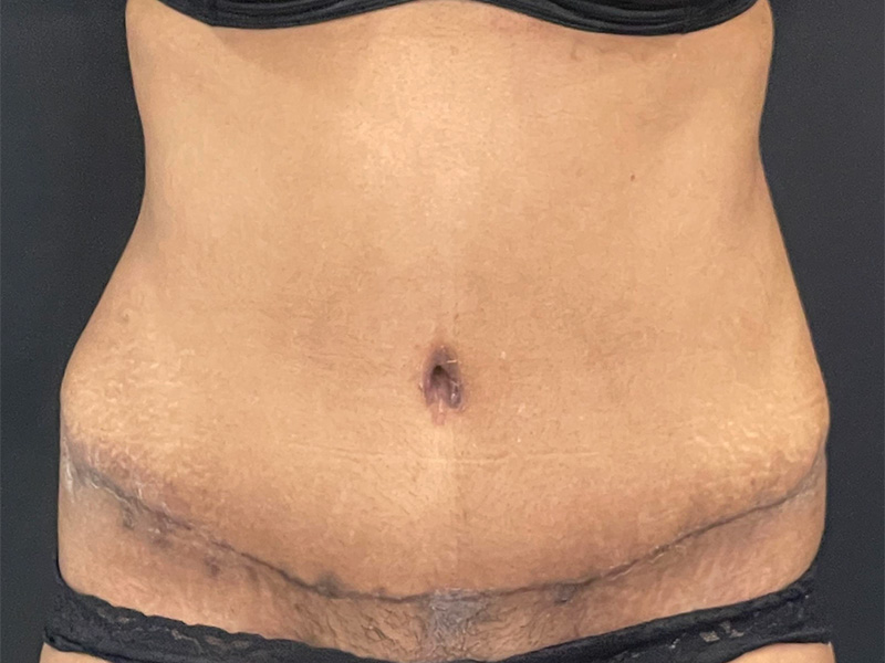 Tummy Tuck New Jersey Patient 7 Front After