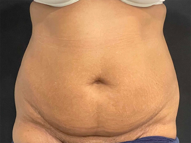 Tummy Tuck New Jersey Patient 7 Front Before