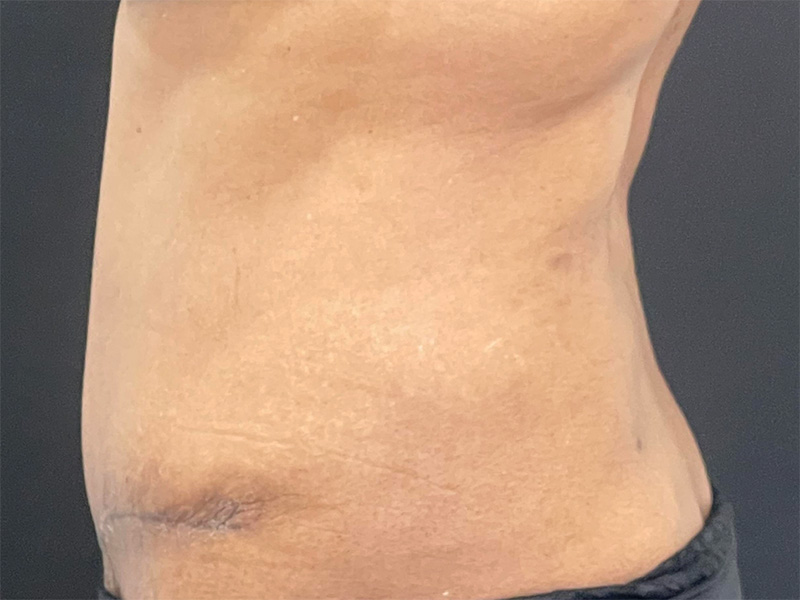 Tummy Tuck New Jersey Patient 7 Lateral After