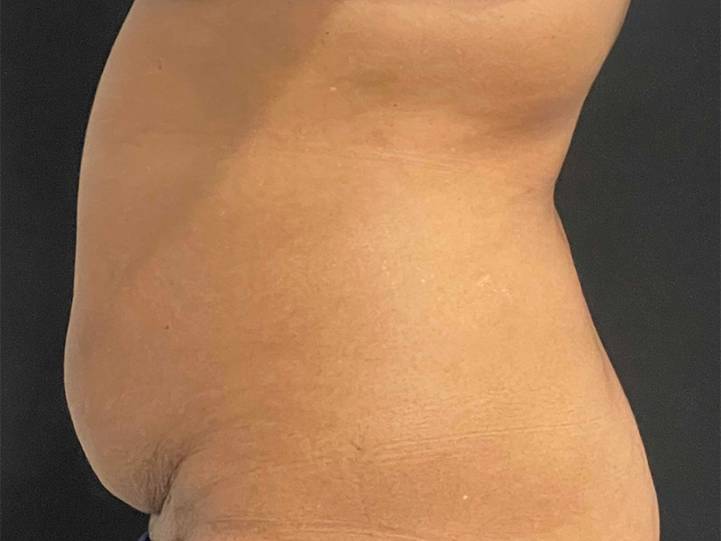 Tummy Tuck New Jersey Patient 7 Lateral Before