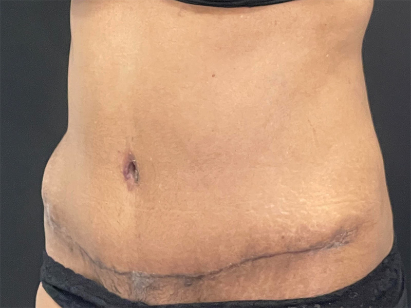 Tummy Tuck New Jersey Patient 7 Oblique After