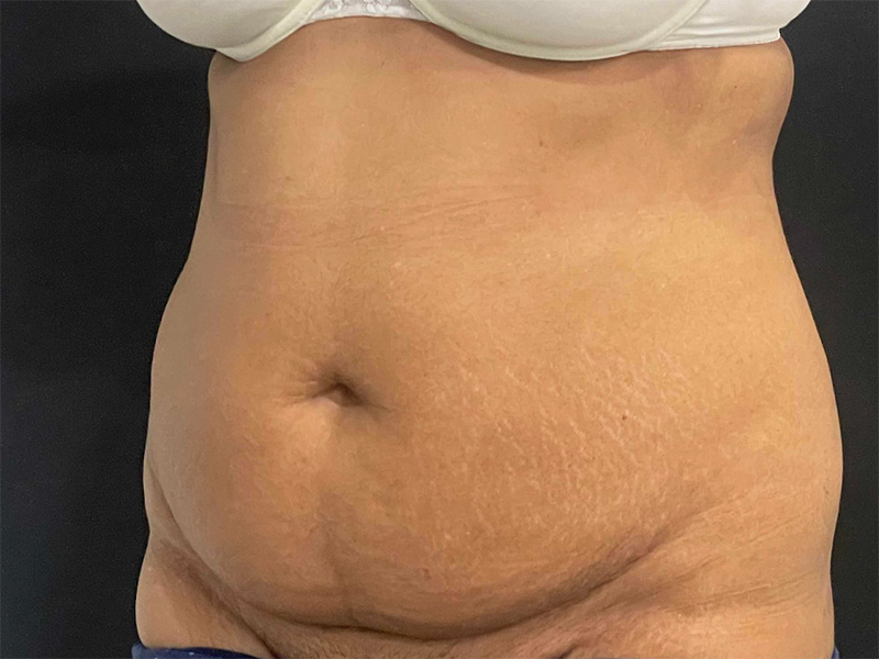 Tummy Tuck New Jersey Patient 7 Oblique Before