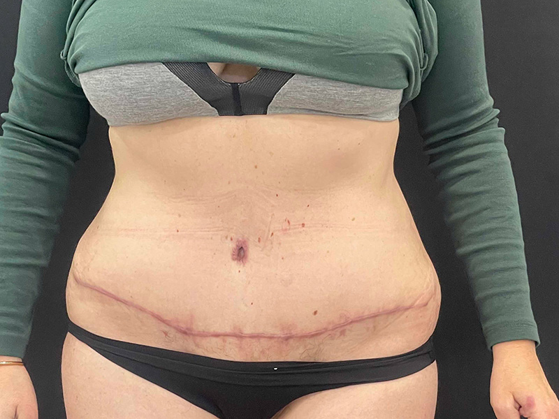 Tummy Tuck New Jersey Photos Front After 1