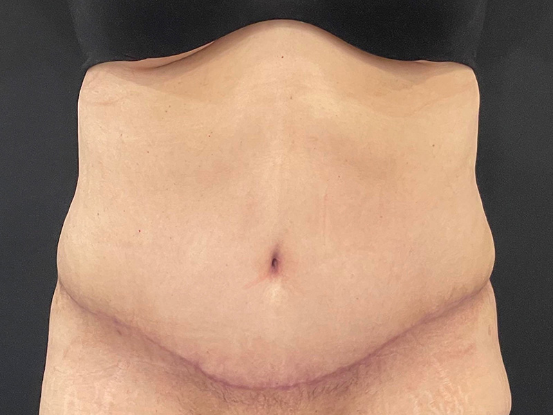 Tummy Tuck New Jersey Photos Front After