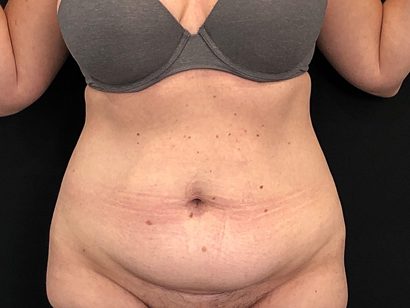Tummy Tuck New Jersey Photos Front Before