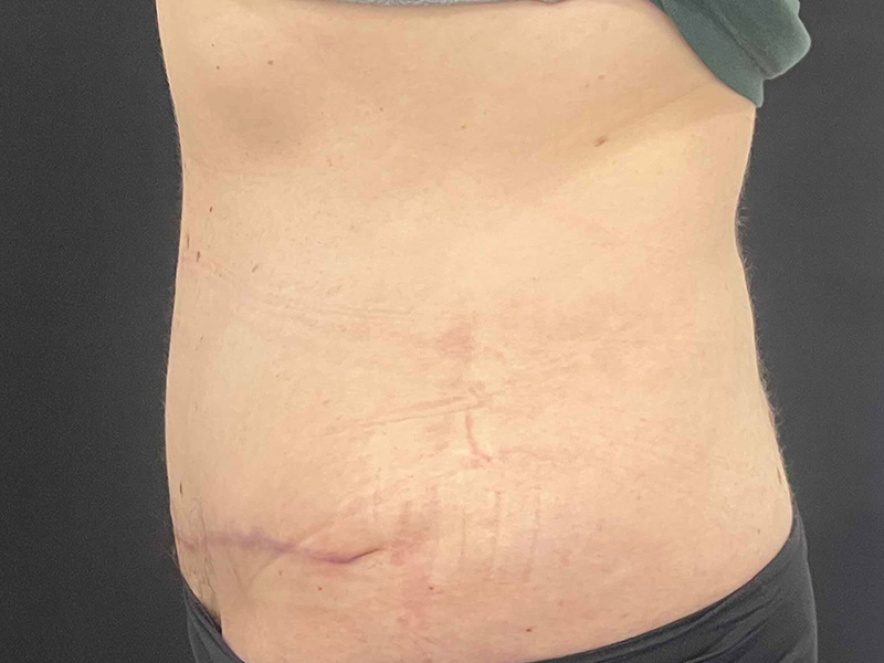 Tummy Tuck New Jersey Photos Lateral After