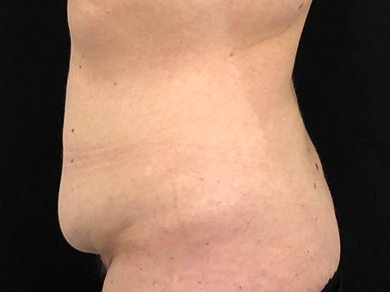 Tummy Tuck New Jersey Photos Lateral Before
