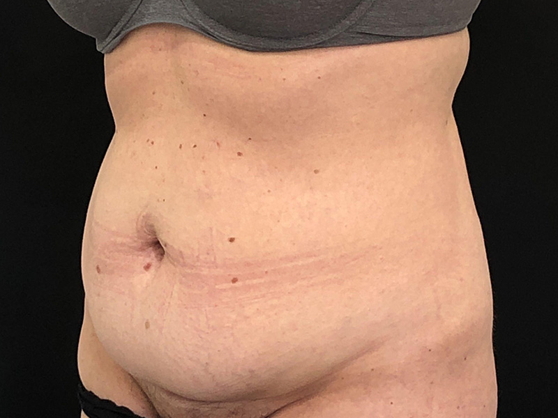 Tummy Tuck New Jersey Photos Oblique Before