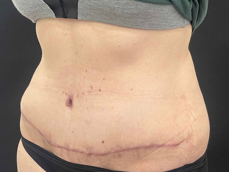 Tummy Tuck New Jersey Photos Obliquie After