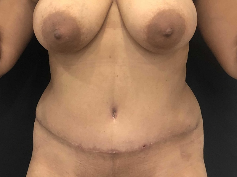 Tummy Tuck New Jersey Front After